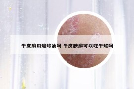 牛皮癣用蟾蜍油吗 牛皮肤癣可以吃牛蛙吗