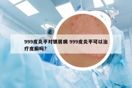 999皮炎平对银屑病 999皮炎平可以治疗皮癣吗?