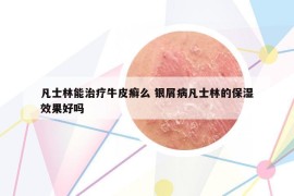 凡士林能治疗牛皮癣么 银屑病凡士林的保湿效果好吗