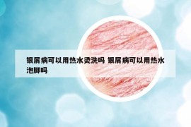 银屑病可以用热水烫洗吗 银屑病可以用热水泡脚吗