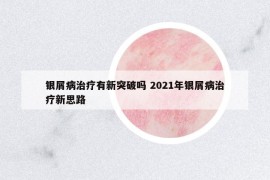 银屑病治疗有新突破吗 2021年银屑病治疗新思路