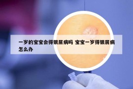 一岁的宝宝会得银屑病吗 宝宝一岁得银屑病怎么办