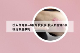 抗人白介素—8鼠单抗乳膏 抗人白介素8鼠根治银屑病吗