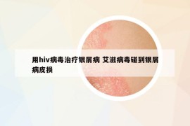 用hiv病毒治疗银屑病 艾滋病毒碰到银屑病皮损