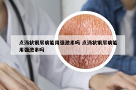 点滴状银屑病能用强激素吗 点滴状银屑病能用强激素吗