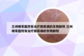 兰州哪家医院有治疗银屑病的生物制剂 兰州哪家医院有治疗银屑病的生物制剂