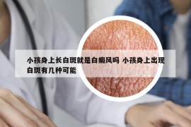 小孩身上长白斑就是白癜风吗 小孩身上出现白斑有几种可能