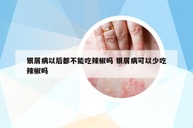 银屑病以后都不能吃辣椒吗 银屑病可以少吃辣椒吗