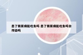 患了银屑病能吃鱼吗 患了银屑病能吃鱼吗会传染吗