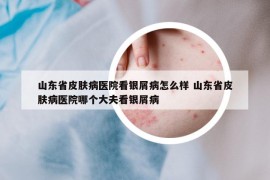 山东省皮肤病医院看银屑病怎么样 山东省皮肤病医院哪个大夫看银屑病