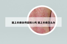 腿上长癣会传染别人吗 腿上长癣怎么办