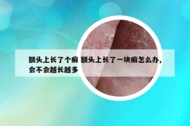 额头上长了个癣 额头上长了一块癣怎么办,会不会越长越多