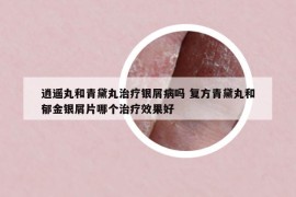 逍遥丸和青黛丸治疗银屑病吗 复方青黛丸和郁金银屑片哪个治疗效果好