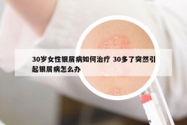 30岁女性银屑病如何治疗 30多了突然引起银屑病怎么办