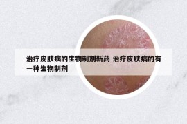 治疗皮肤病的生物制剂新药 治疗皮肤病的有一种生物制剂