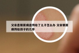 父亲患银屑病遗传给了儿子怎么办 父亲银屑病传给孩子的几率