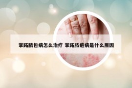 掌跖脓包病怎么治疗 掌跖脓疱病是什么原因