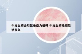 牛皮血癣会引起免疫力低吗 牛皮血癣晚期能活多久