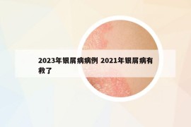 2023年银屑病病例 2021年银屑病有救了