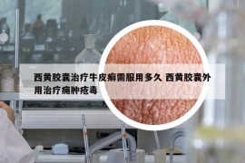 西黄胶囊治疗牛皮癣需服用多久 西黄胶囊外用治疗痈肿疮毒