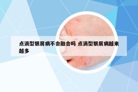 点滴型银屑病不会融合吗 点滴型银屑病越来越多