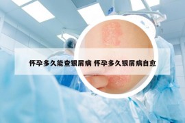 怀孕多久能查银屑病 怀孕多久银屑病自愈