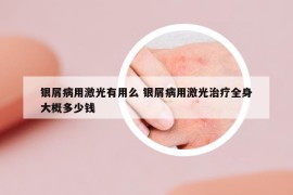 银屑病用激光有用么 银屑病用激光治疗全身大概多少钱