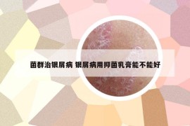 菌群治银屑病 银屑病用抑菌乳膏能不能好