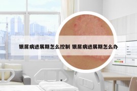 银屑病进展期怎么控制 银屑病进展期怎么办