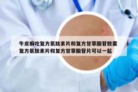 牛皮癣吃复方氨肽素片和复方甘草酸苷胶囊 复方氨肽素片和复方甘草酸苷片可以一起