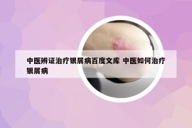 中医辨证治疗银屑病百度文库 中医如何治疗银屑病