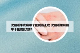 沈阳看牛皮癣哪个医院最正规 沈阳看银屑病哪个医院比较好