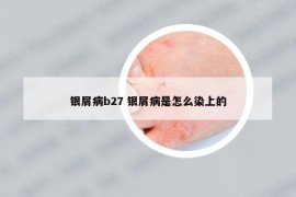 银屑病b27 银屑病是怎么染上的