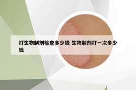 打生物制剂检查多少钱 生物制剂打一次多少钱