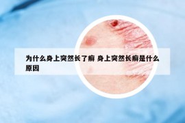 为什么身上突然长了癣 身上突然长癣是什么原因