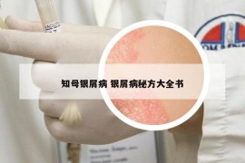 知母银屑病 银屑病秘方大全书