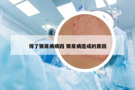 得了银屑病病因 银屑病造成的原因