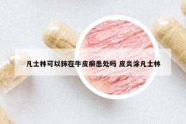 凡士林可以抹在牛皮癣患处吗 皮炎涂凡士林