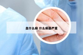 盘什么癣 什么癣最严重