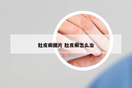 肚皮癣图片 肚皮癣怎么治