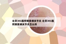 北京301医院银屑病关节炎 北京301医院银屑病关节炎怎么样