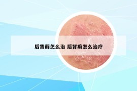 后背藓怎么治 后背癣怎么治疗