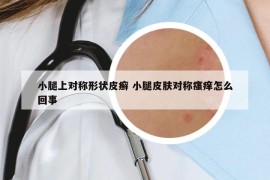 小腿上对称形状皮癣 小腿皮肤对称瘙痒怎么回事