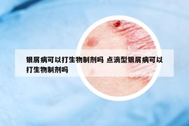 银屑病可以打生物制剂吗 点滴型银屑病可以打生物制剂吗