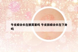 牛皮癣会长在腋窝里吗 牛皮肤癣会长在下身吗