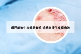 爆汗能治牛皮癣患者吗 运动出汗牛皮廨功效