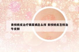 青核桃皮冶疗银屑病怠么样 青核桃皮怎样治牛皮鲜