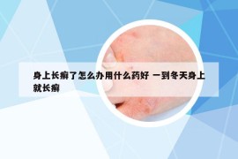 身上长癣了怎么办用什么药好 一到冬天身上就长癣