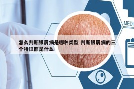 怎么判断银屑病是哪种类型 判断银屑病的三个特征都是什么