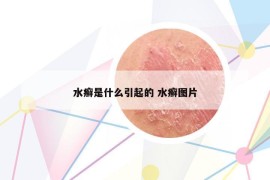 水癣是什么引起的 水癣图片